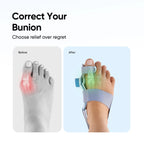 Frido Orthotics Bunion Corrector